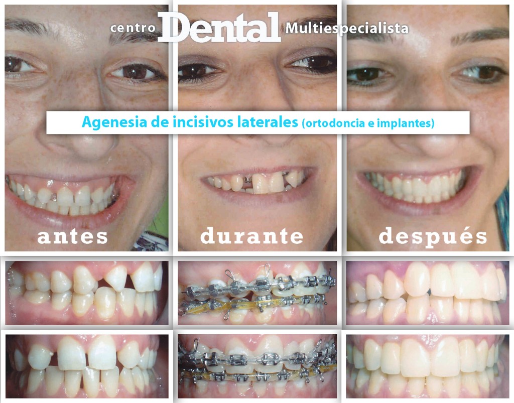 agenesia_incisivos_laterales_ortodoncia_implantes_centro_dental_multiespecialista