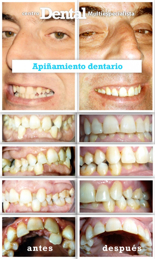 ortodoncia_apinamiento_centro_dental_multiespecialista_1
