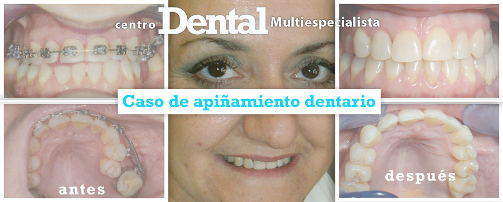 ortodoncia_apinamiento_centro_dental_multiespecialista_2