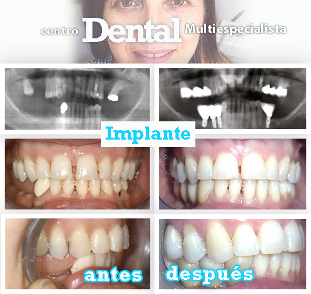 implante_centro_dental_multiespecialista_7