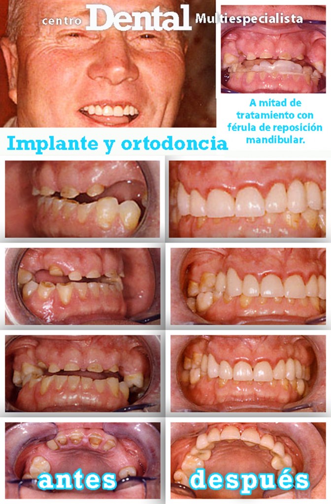 implante_ortodoncia_centro_dental_multiespecialista_5