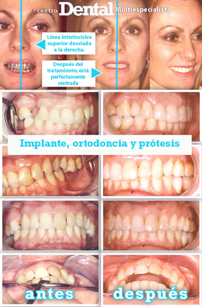 implante_ortodoncia_protesis_dentario_centro_dental_multiespecialista_4