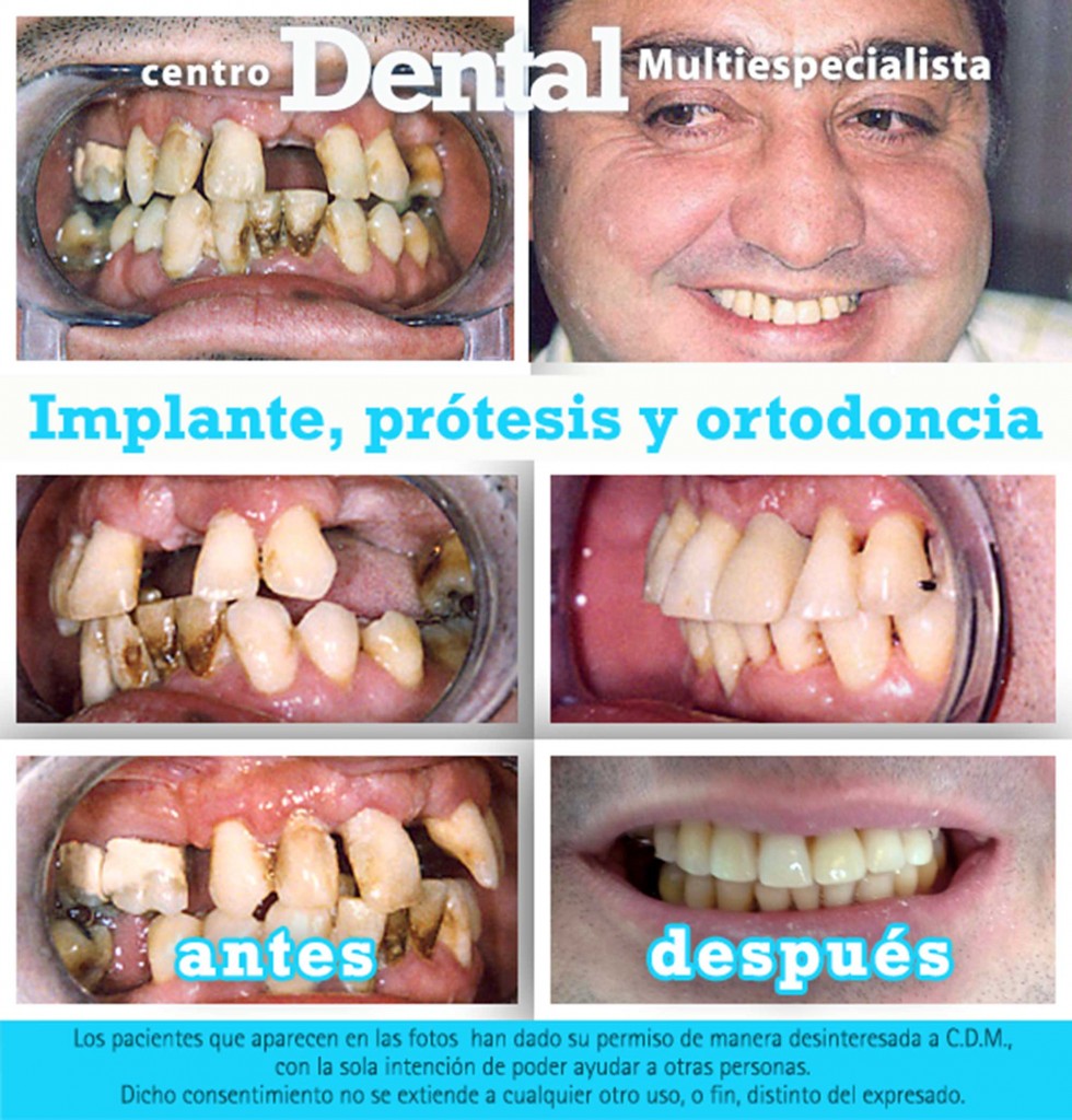 implante_protesis_ortodoncia_centro_dental_multiespecialista_6