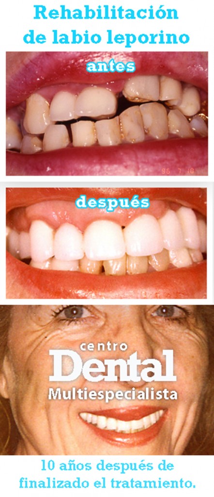 implante_rehabilitacion_labio_leporino_centro_dental_multiespecialista_8