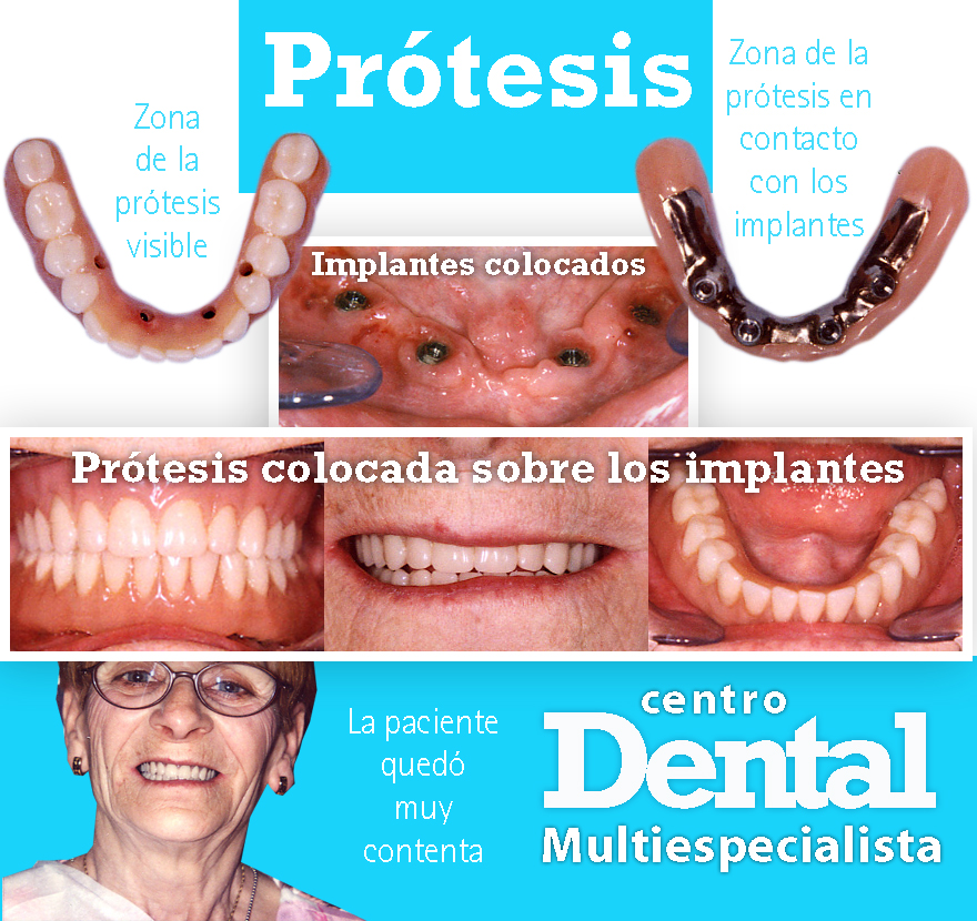 implante_rehabilitacion_labio_leporino_centro_dental_multiespecialista_9