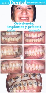 Caso de ortodoncia, implantes y prótesis
