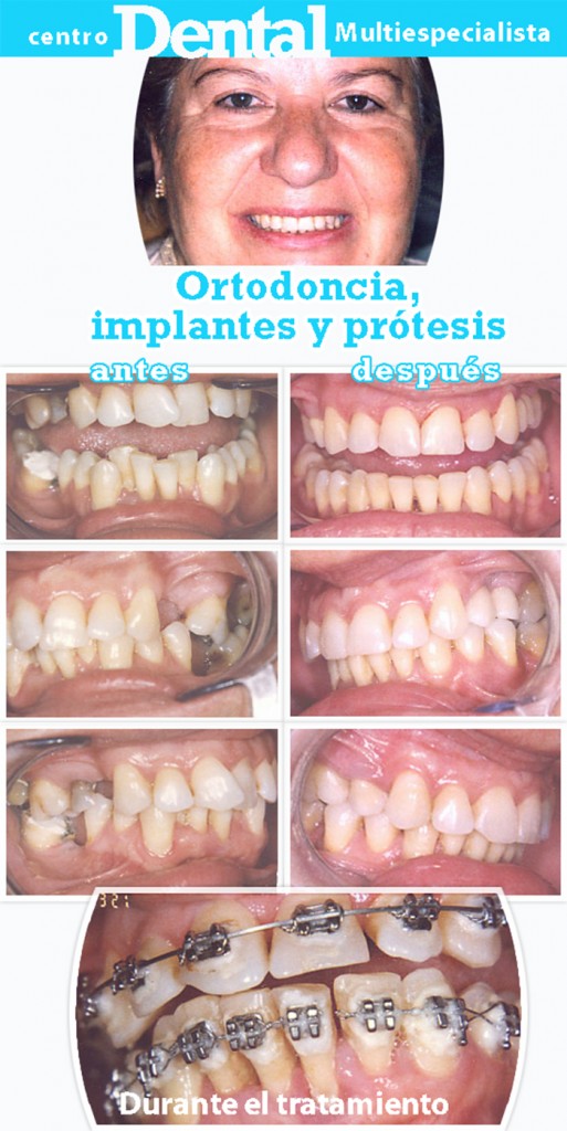 ortodoncia_implantes_protesis_centro_dental_multiespecialista_7