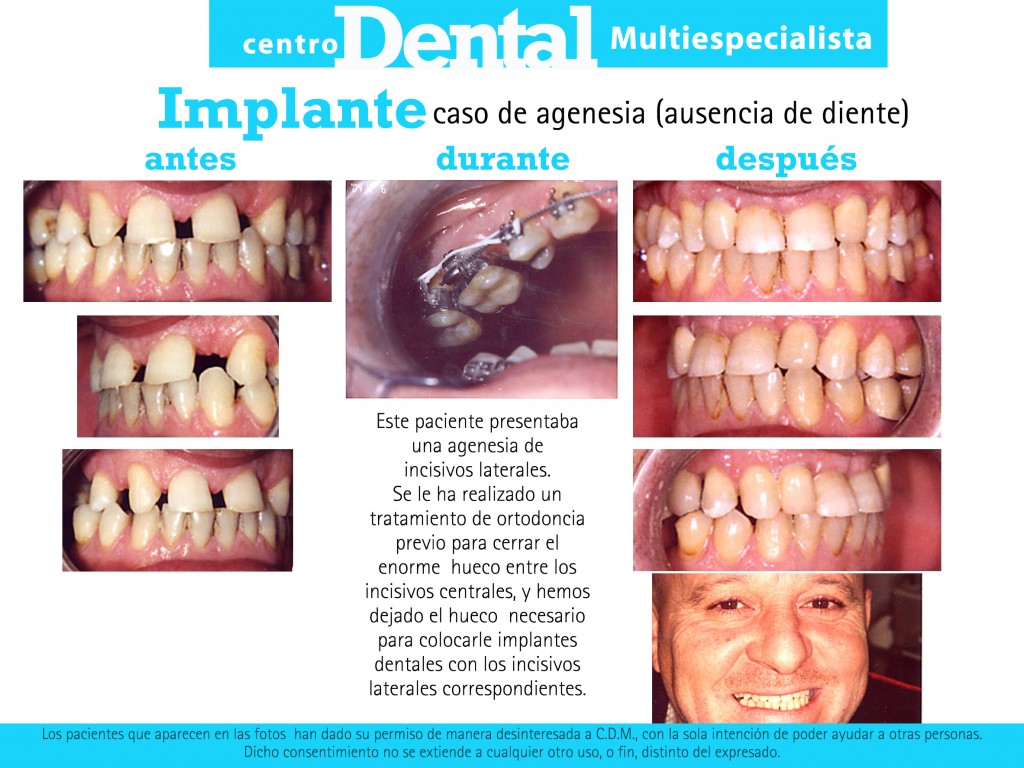 implante_agenesia__dental_multiespecialista_11