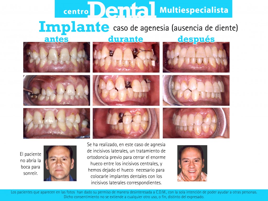 implante_agenesia__dental_multiespecialista_12