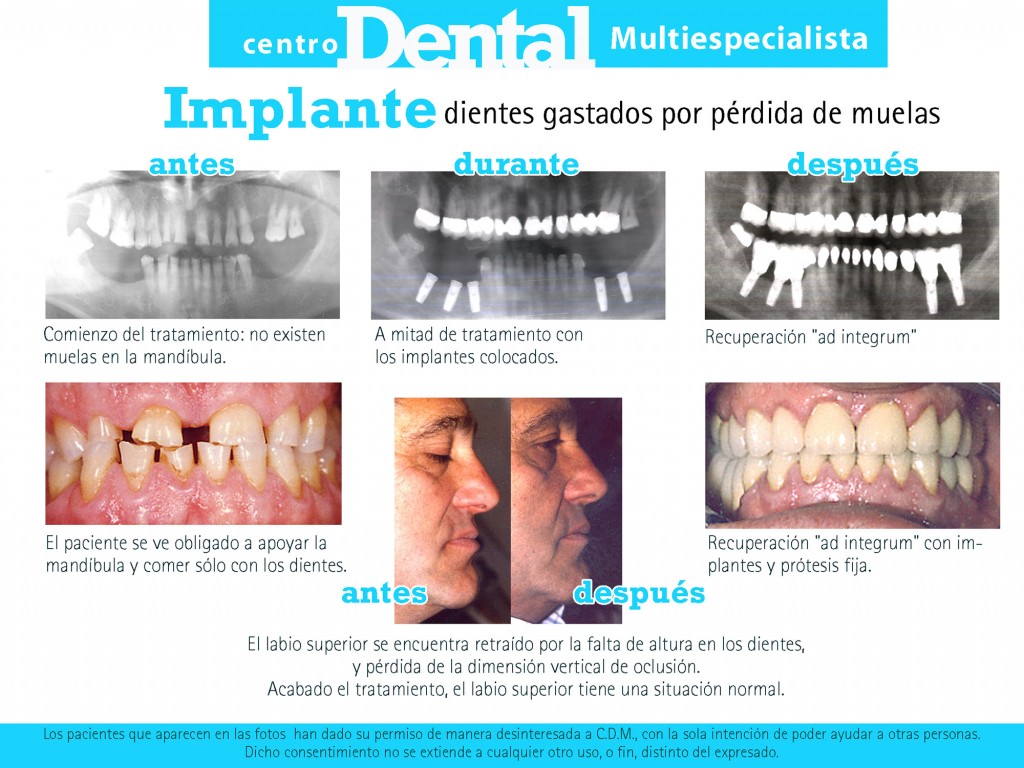 implante_centro_dental_multiespecialista_10