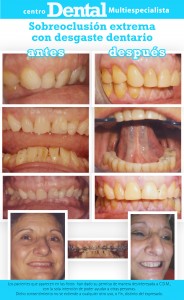 Caso de sobreoclusión extrema con desgaste dentario