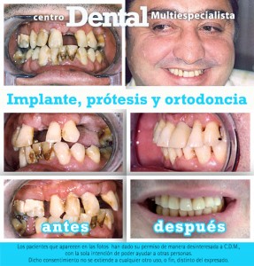 Caso complejo de ortodoncia, prótesis e implantes
