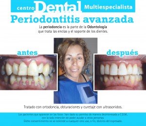 Caso de periodontitis avanzada tratado con ortodoncia, obturaciones y curetaje con ultrasonidos